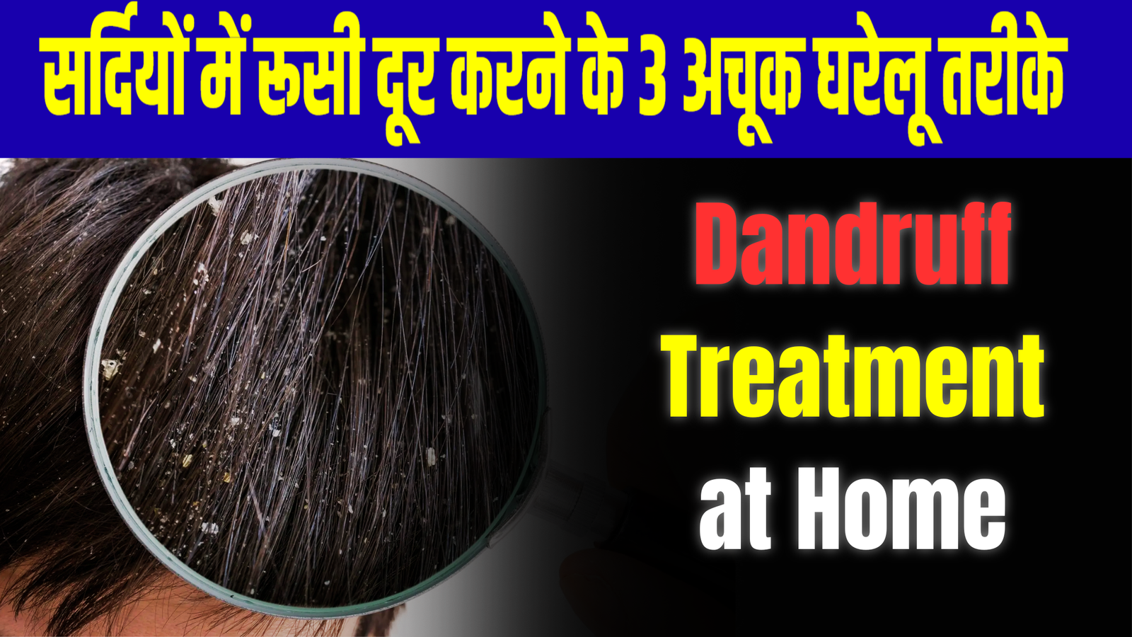 Dandruff Treatment at Home